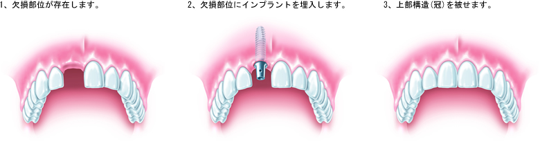 インプラント治療